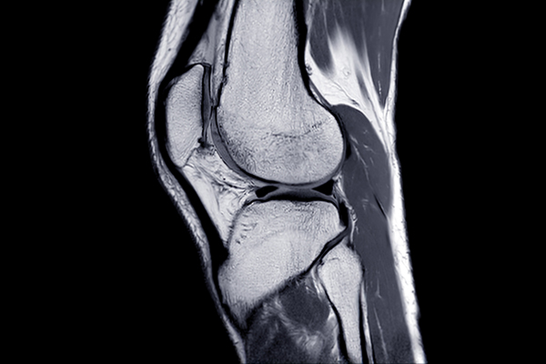 An MRI of a knee joint