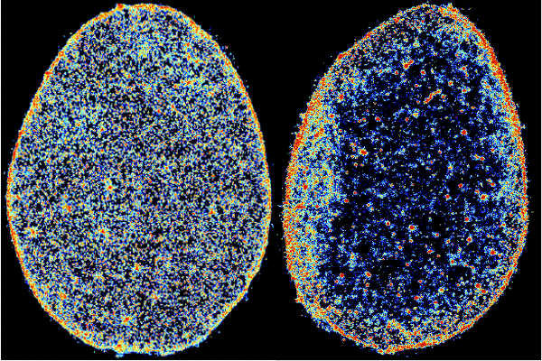 Micrograph images showing cells before and after their chromatin was reshuffled by disease.