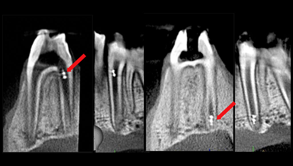 Cone-beam computed tomography image of a microrobot used in a root canal procedure.