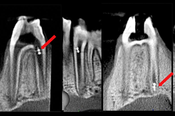 Cone-beam computed tomography image of a microrobot used in a root canal procedure.